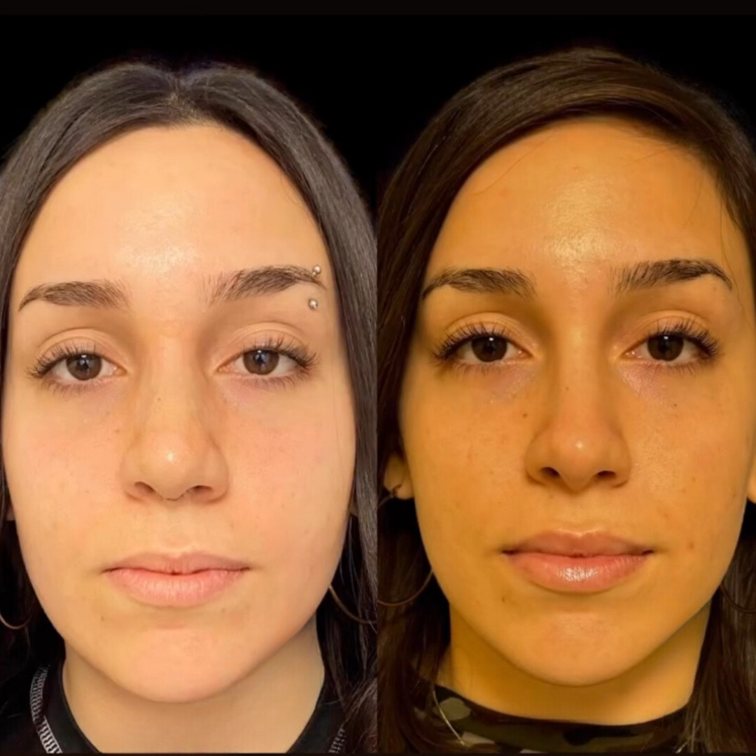 Rhinoplasty with Estedica, Pic 12.png