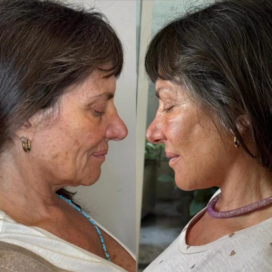 Face Lift, Pic 9.png