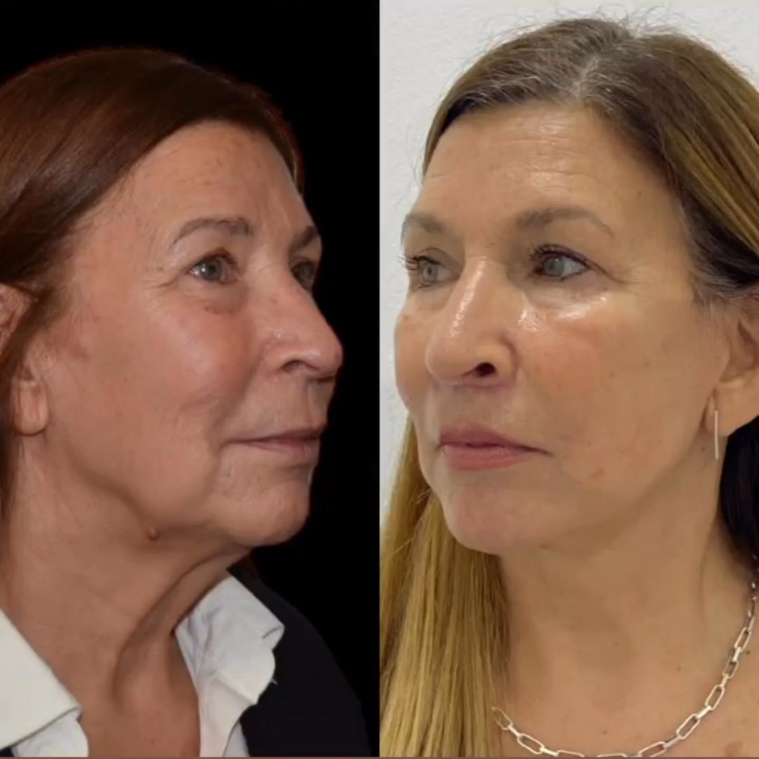 Face Lift, Pic 8.png