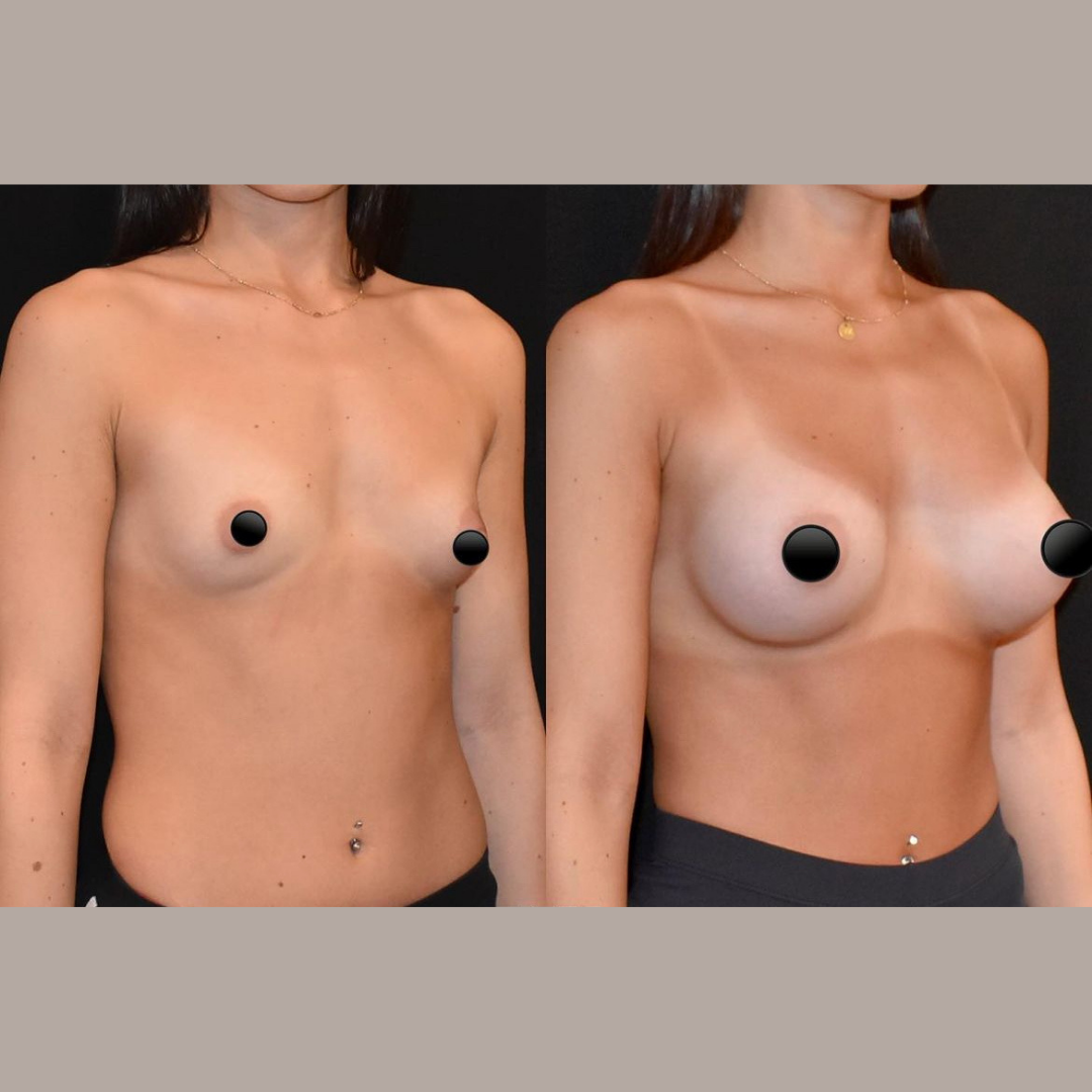 Breast Augmentation, Pic 13.png