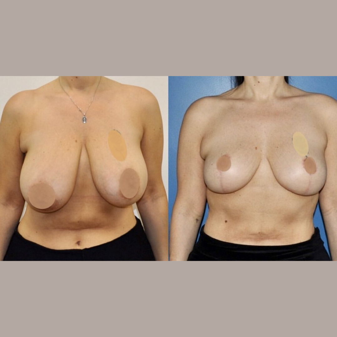 Breast Reduction, Pic 6.png