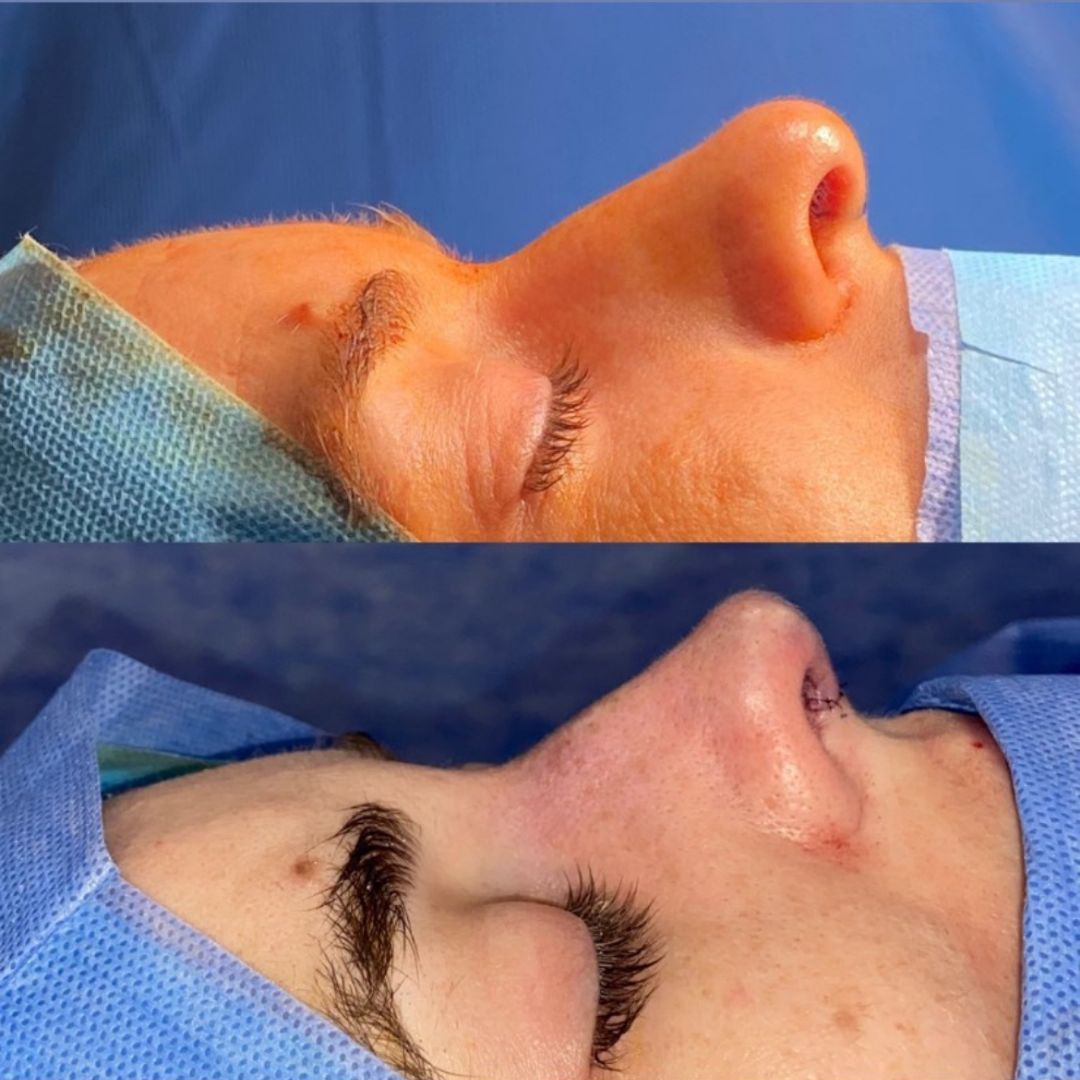 Rhinoplasty in Argentina, Pic 2.png