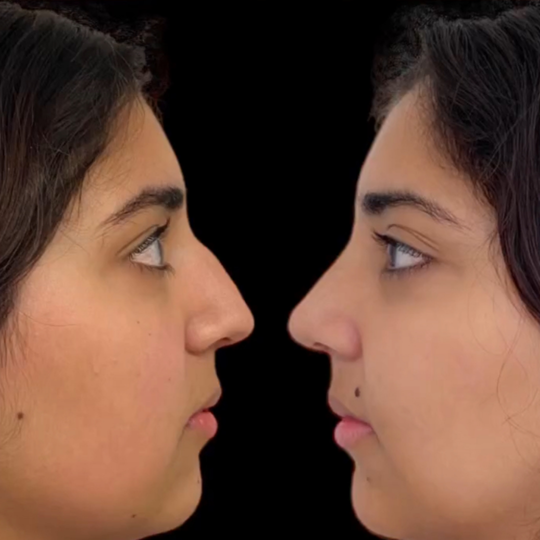 Rhinoplasty in Argentina, Pic 5.png