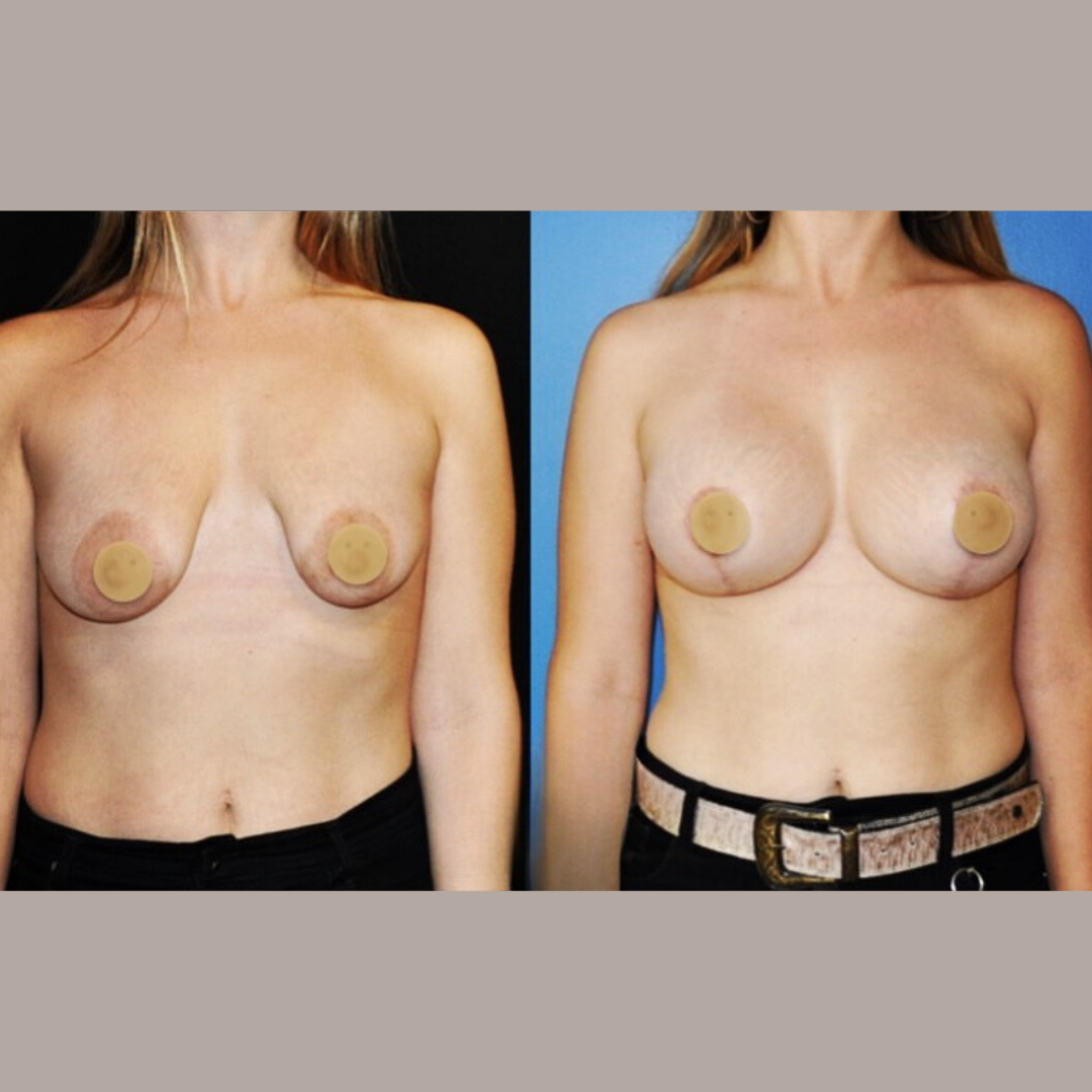Breast Lift and Augmentation, Pic 5.png