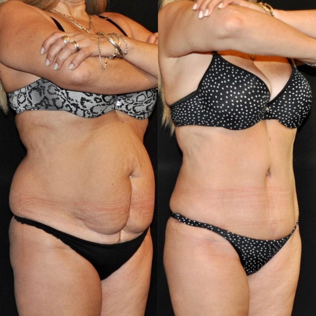 Abdominoplasty, Pic 3.png