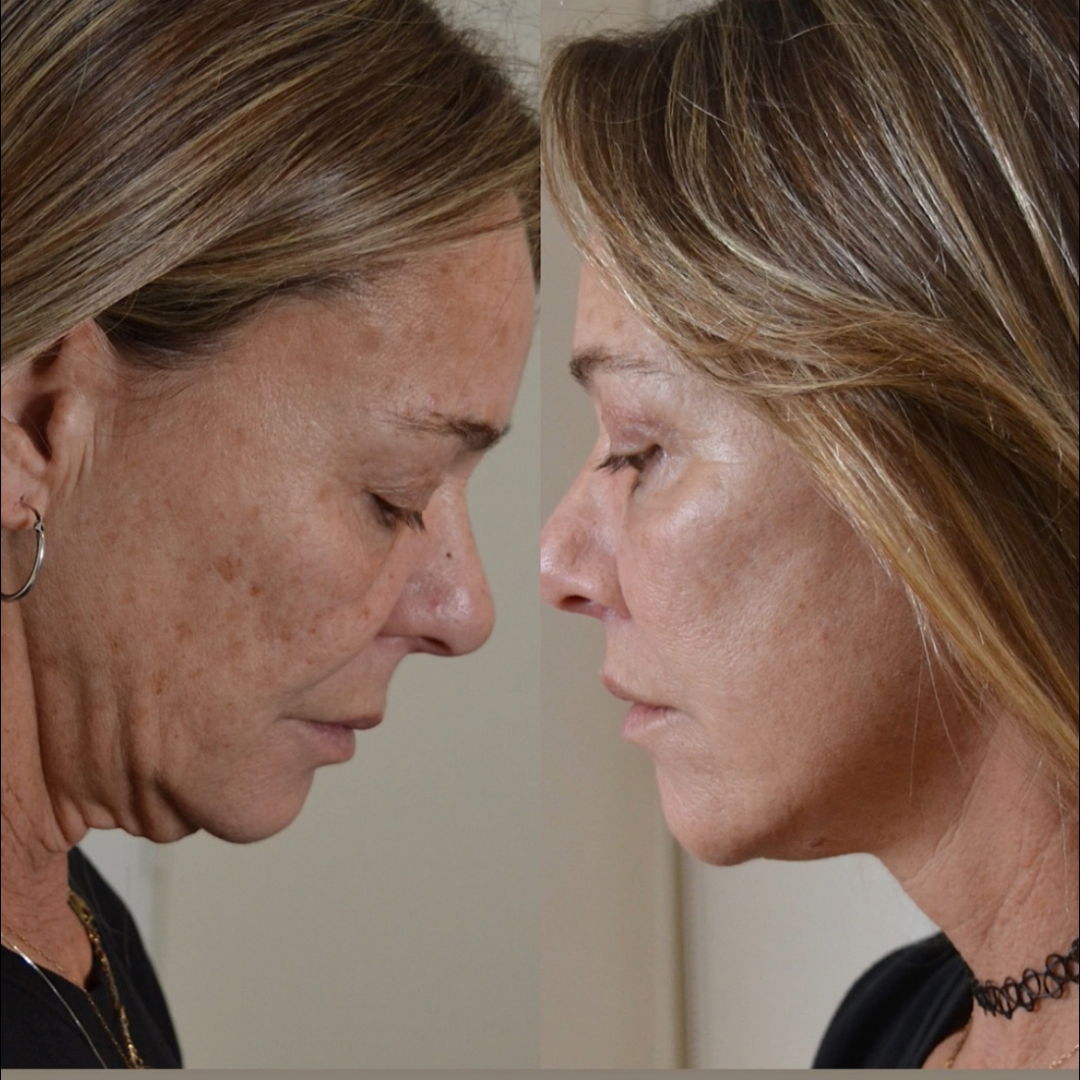 Face Lift, Pic 20.png