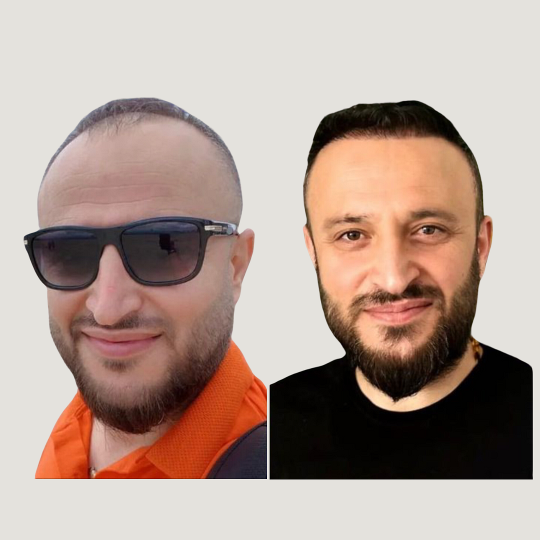 Hair Transplantation, Pic 1.png