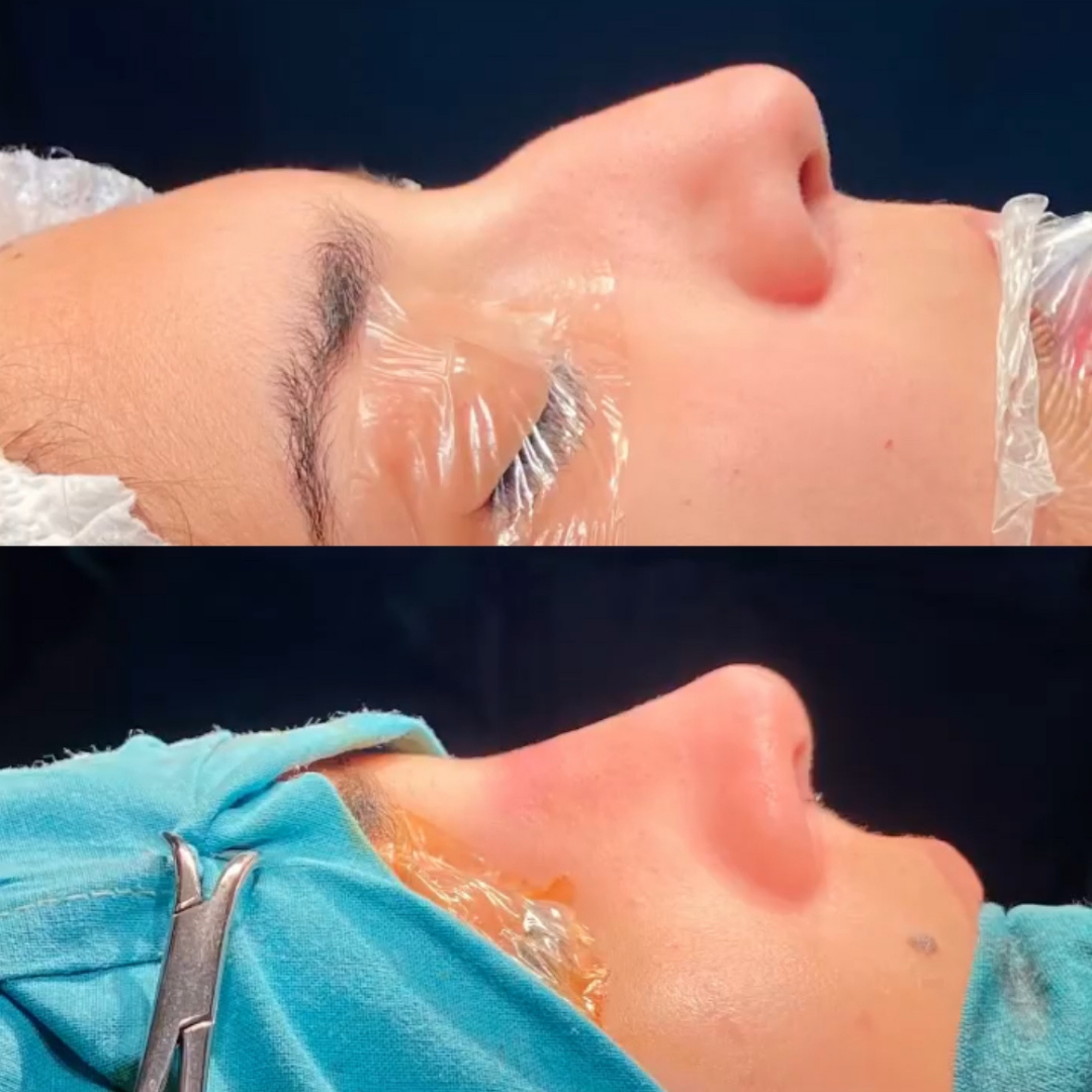 Rhinoplasty in Argentina, Pic 3.png