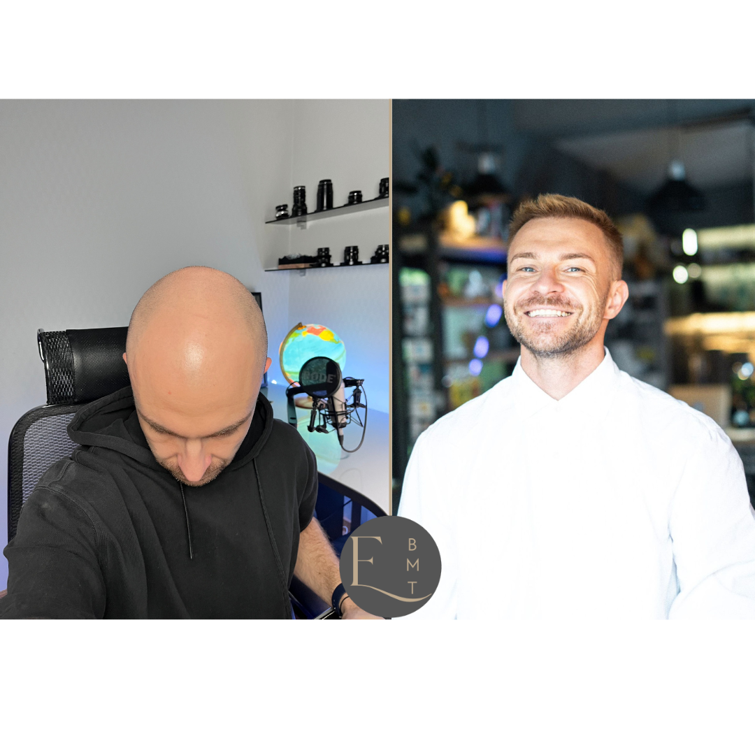 Hair Transplantation, Turkey -2.png