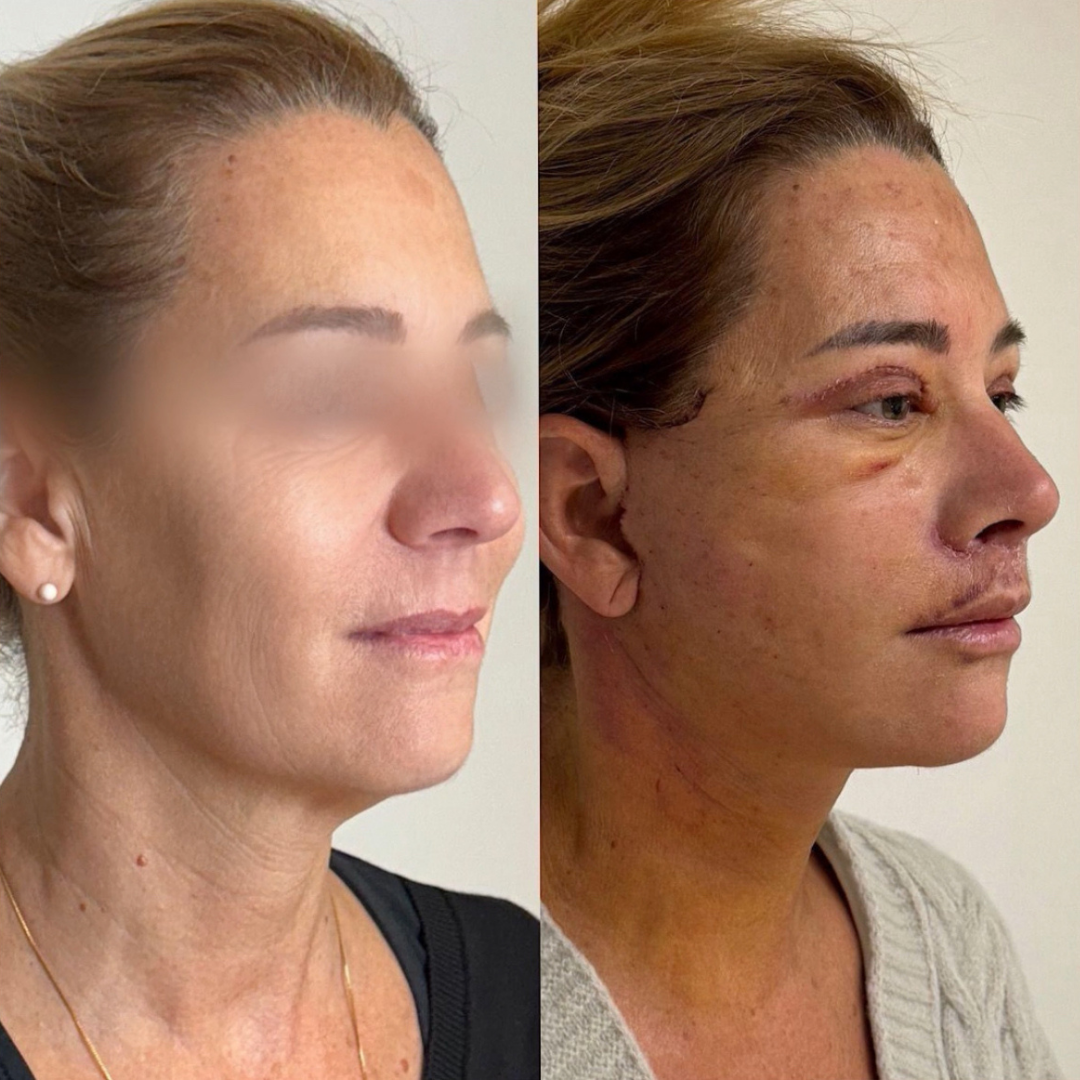 Face Lift, Pic 1.png