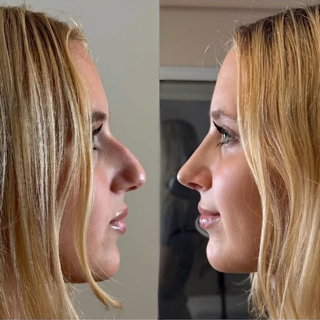 Rhinoplasty with Estedica, Pic 14.png