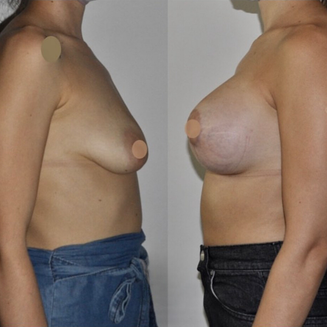 Breast Lift and Augmentation, Pic 2.png