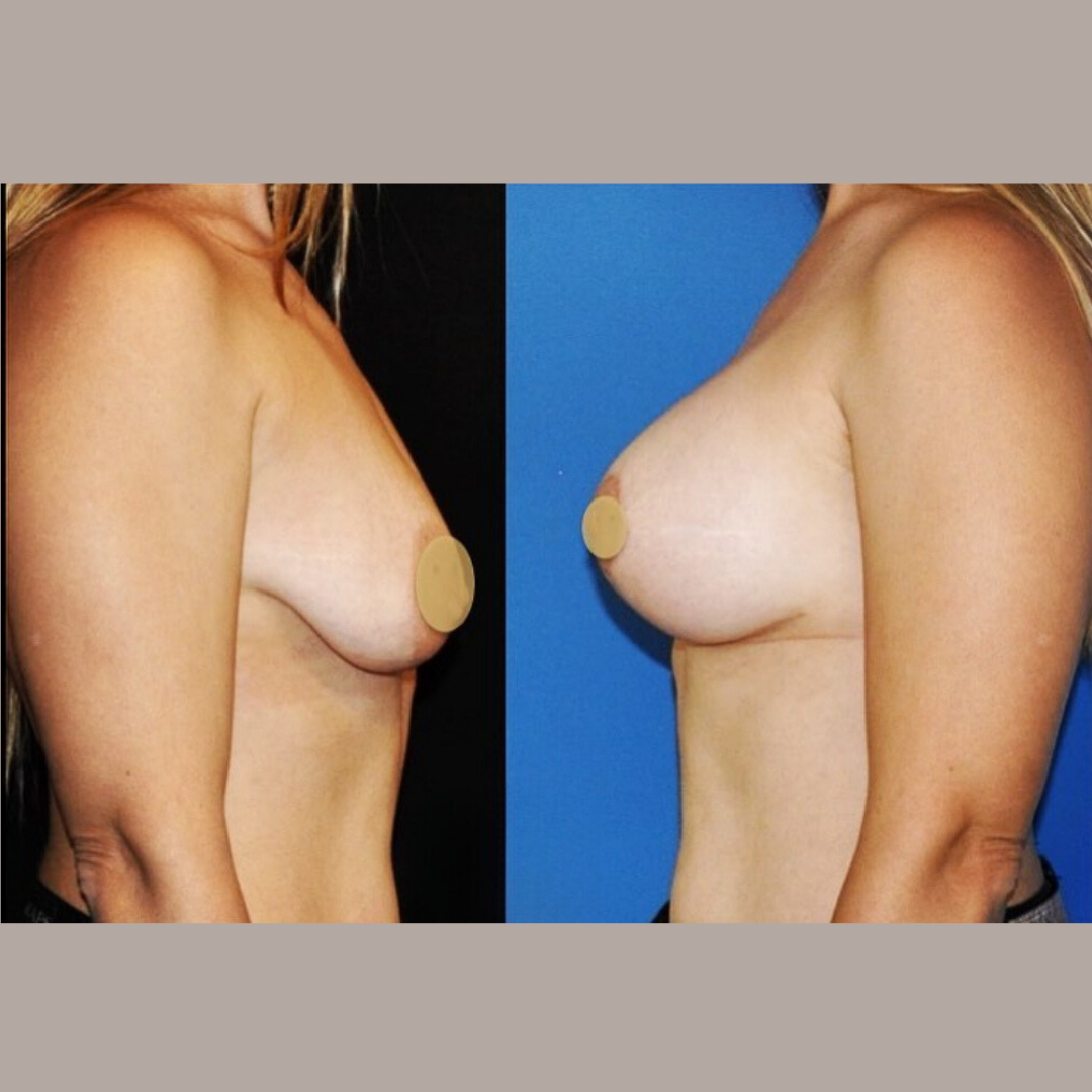 Breast Lift and Augmentation, Pic 6.png