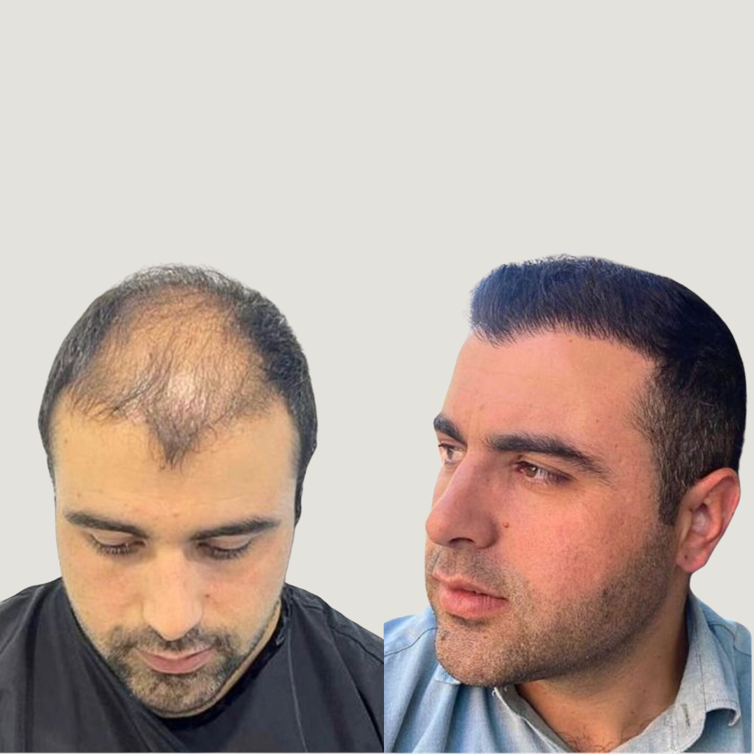 Hair Transplantation Results, Pic 3.png