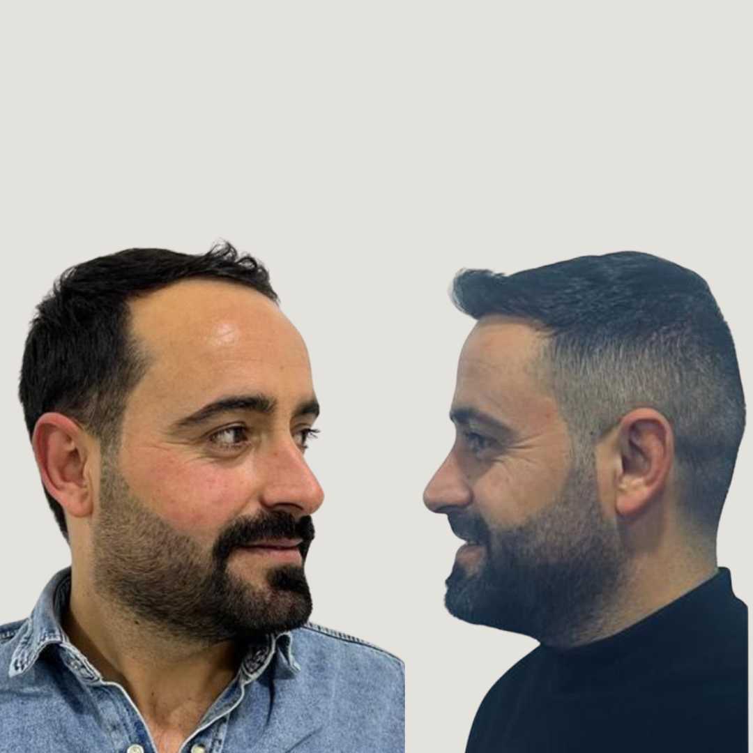 Hair Transplantation, Pic 6.png