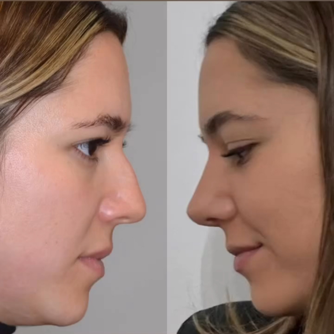 Rhinoplasty with Estedica, Pic 19.png
