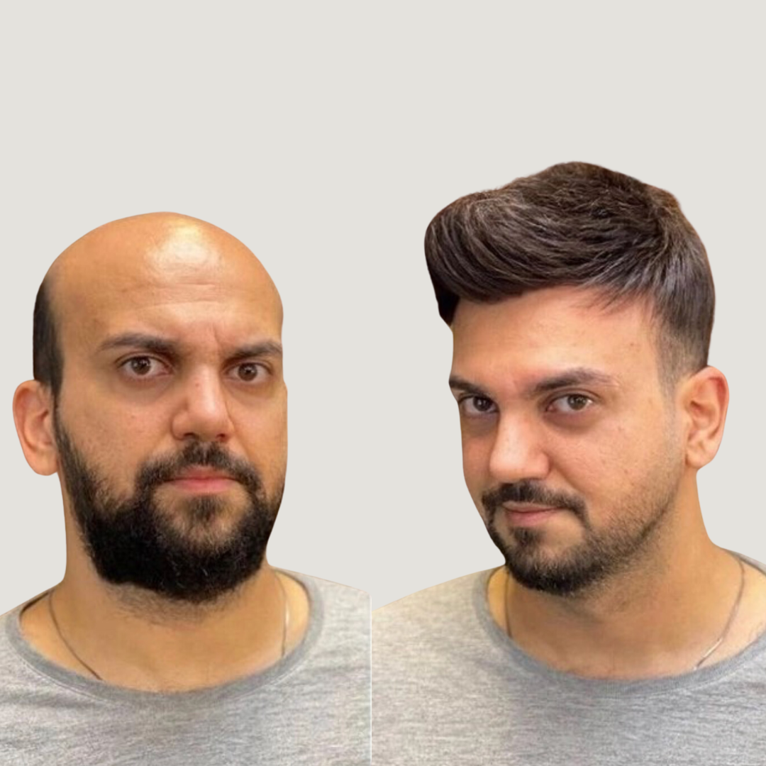 Hair Restoration, Pic 6.png