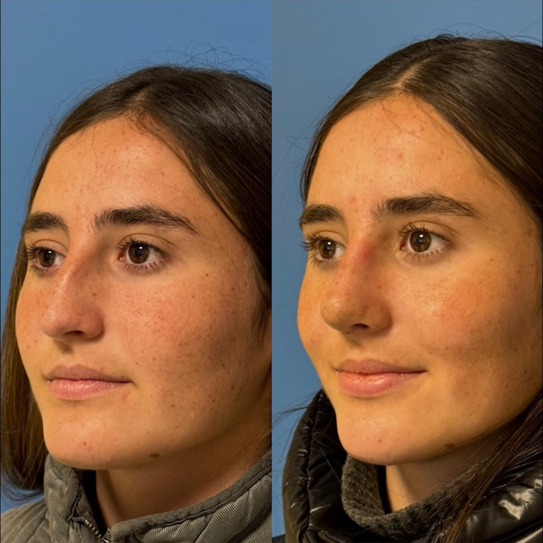 Rhinoplasty with Estedica,Pic 21.png