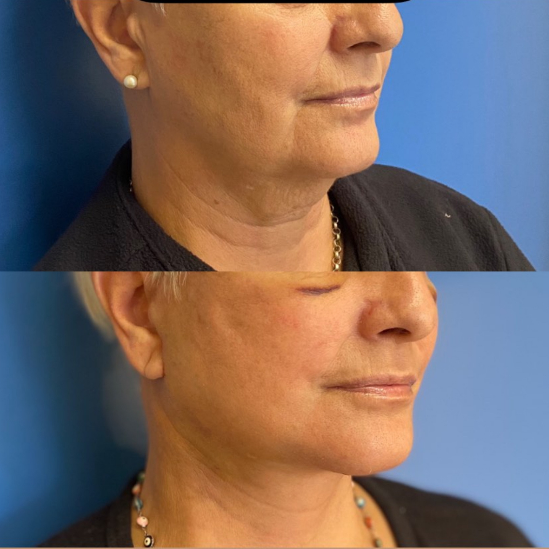 Face Lift, Pic 3.png