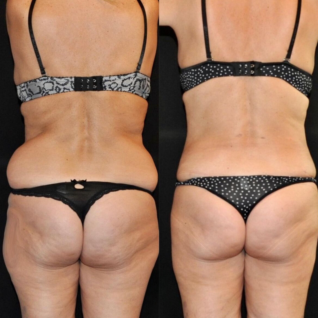 Liposuction, Pic 2.png