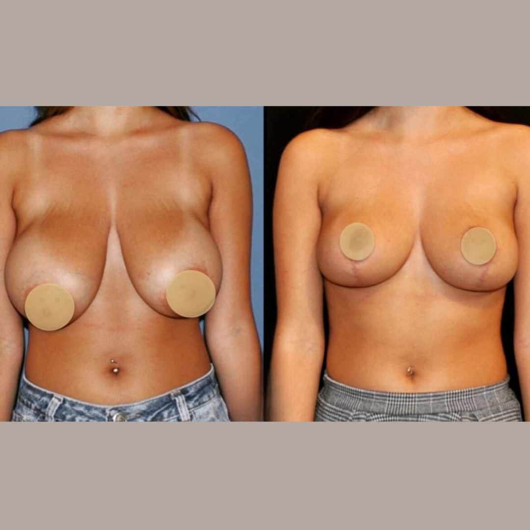 Breast Lift, Pic 2.png