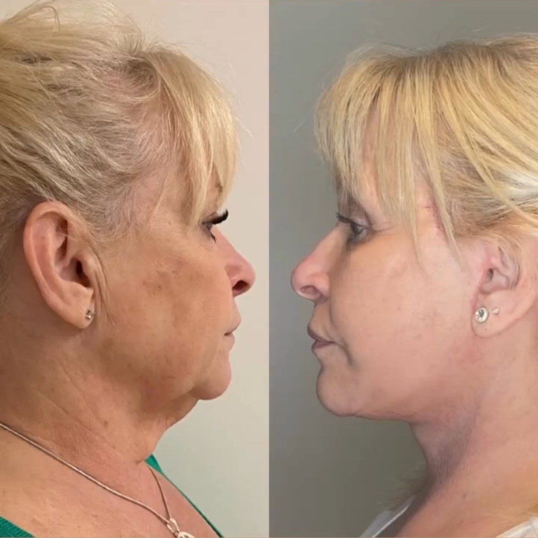 Face Lift, Pic 5.png