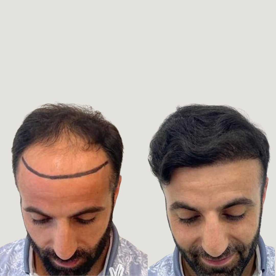 Hair Transplantation Results, Pic 2.png
