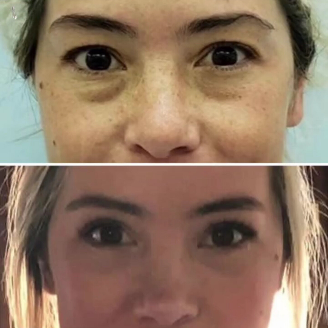 Blepharoplasty, Pic 9.png