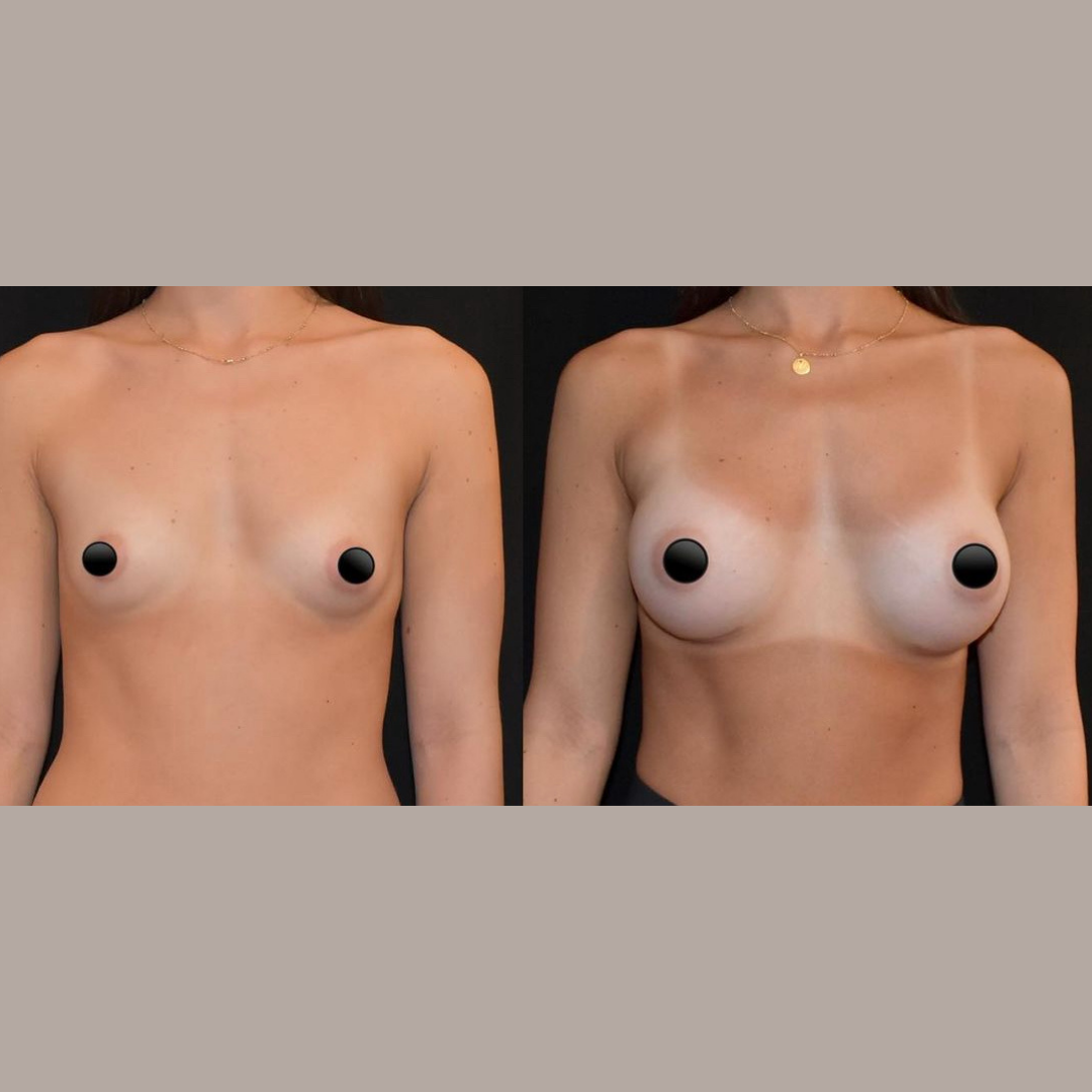Breast Augmentation, Pic 12.png