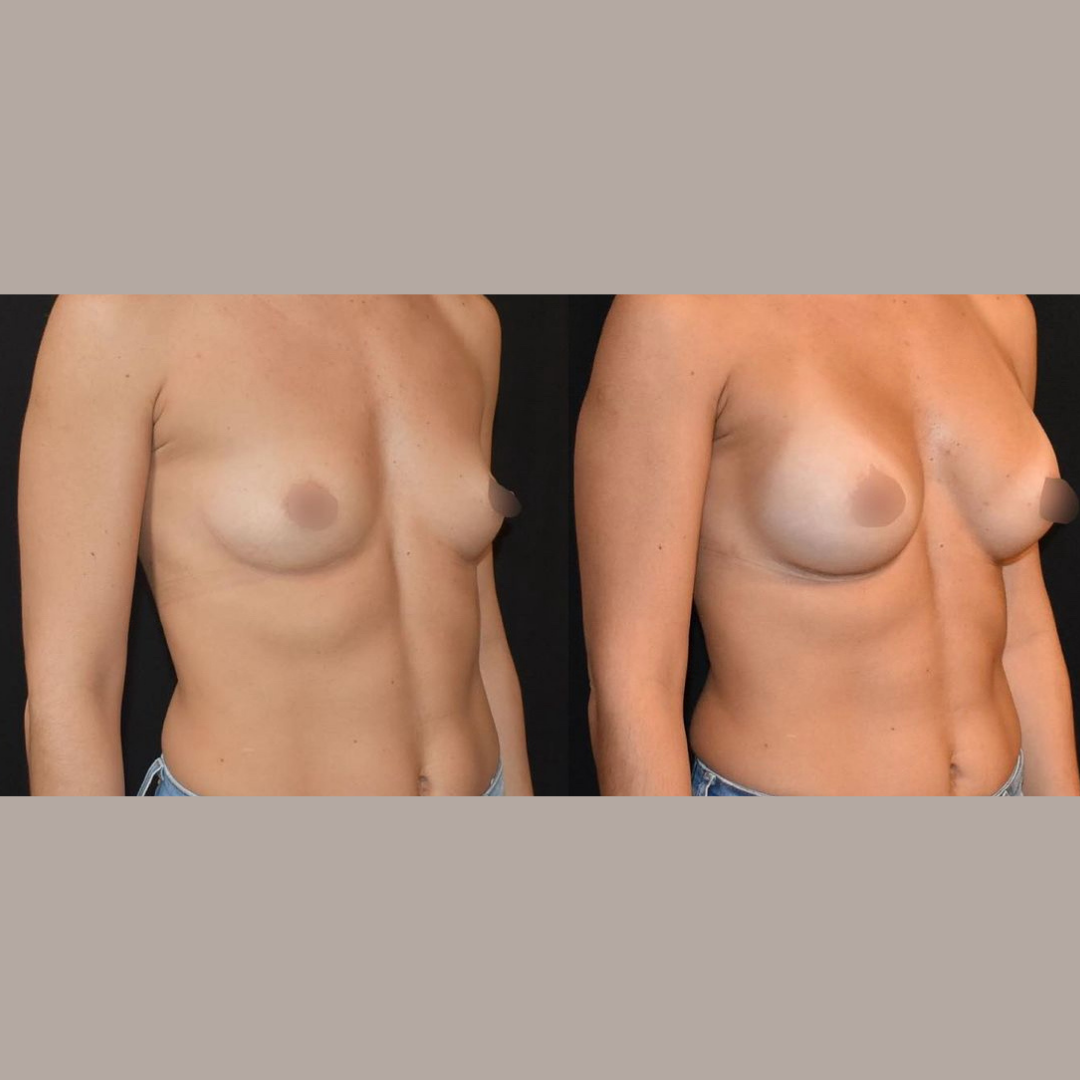 Breast Augmentation, Pic 9.png