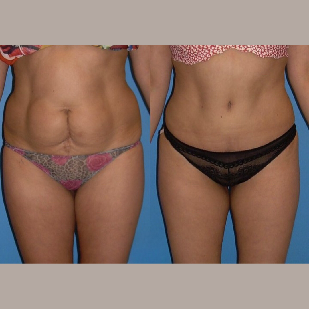Abdominoplasty, Pic 5.png