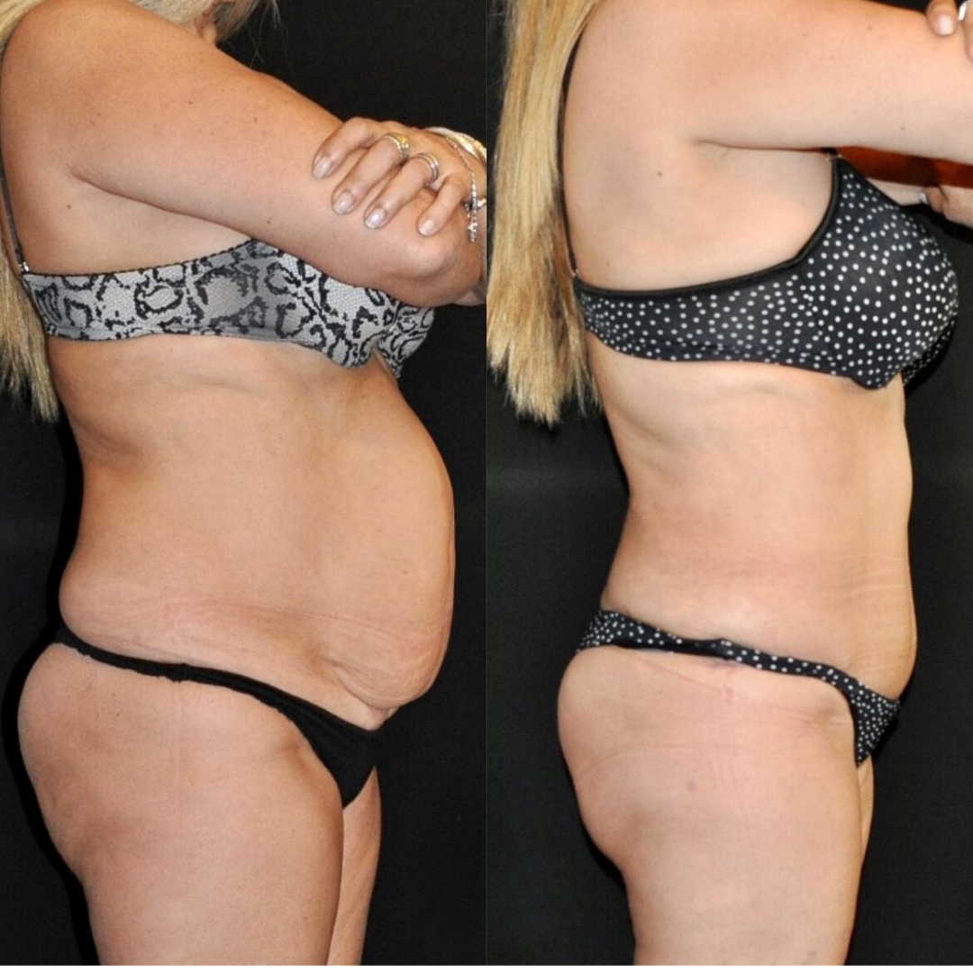 Abdominoplasty, Pic  2.png