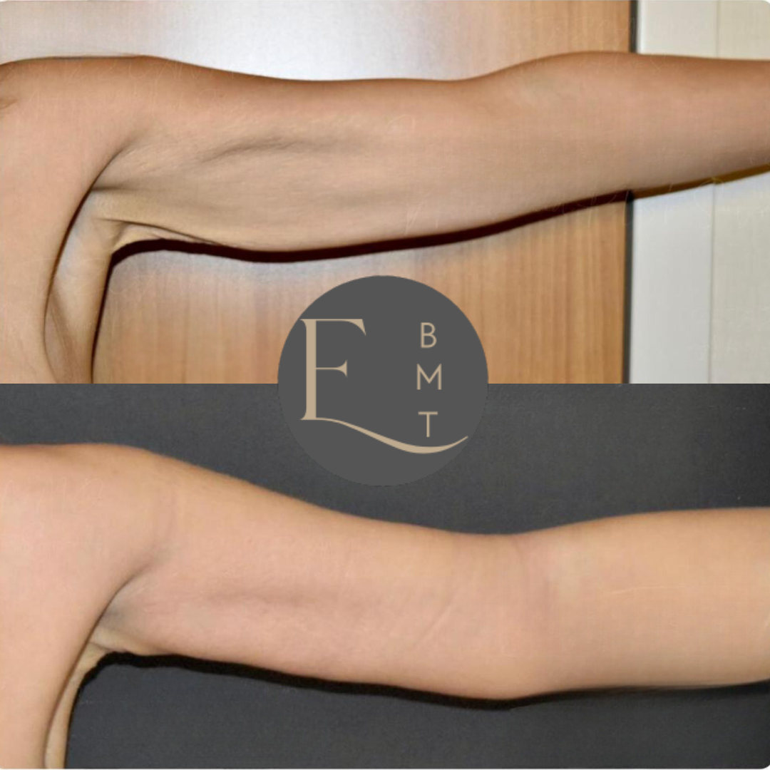 Medical Tourism - Arm Lift.png