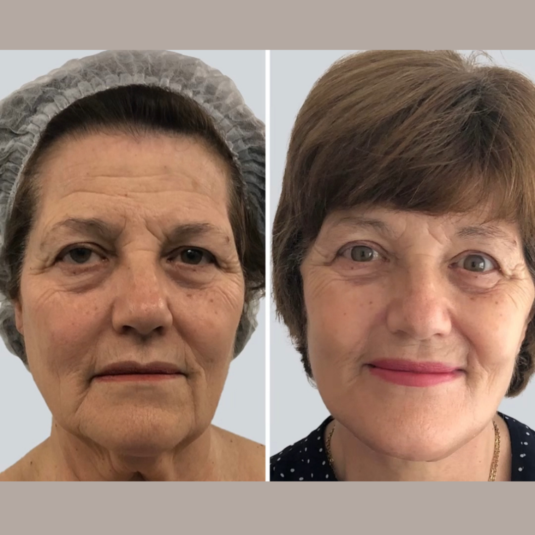 Face Lift, Pic 21.png