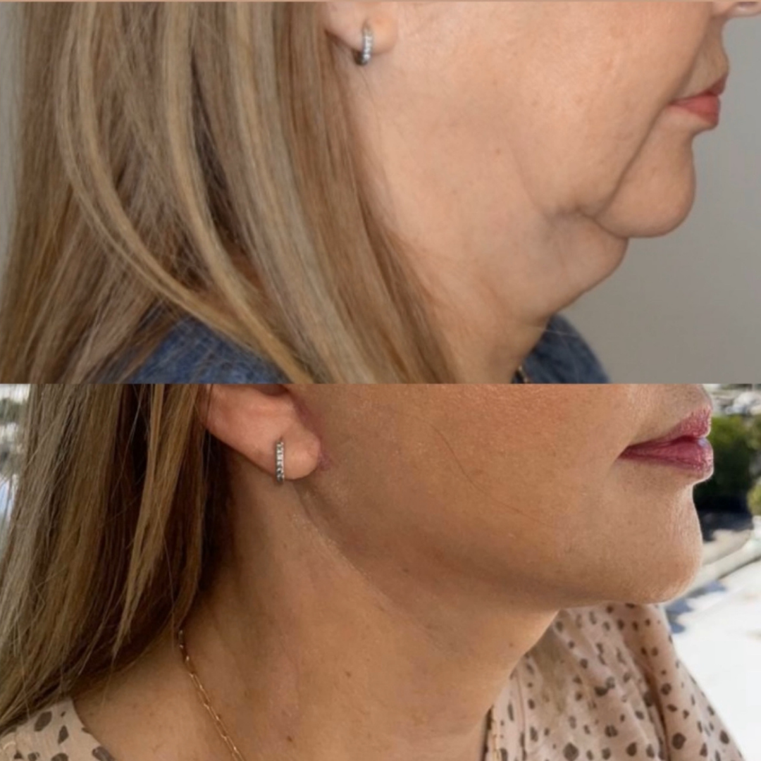 Face Lift, Pic 7.png