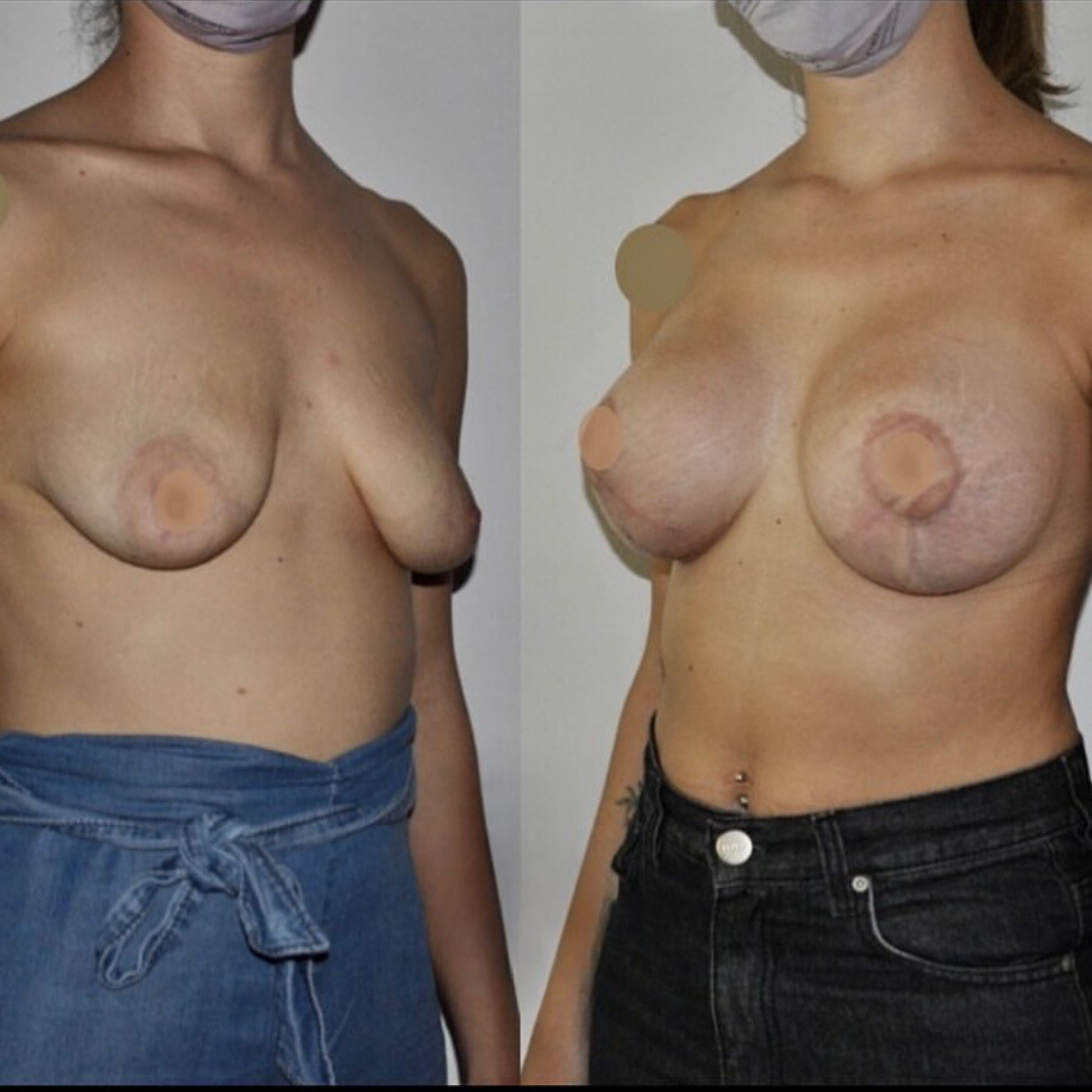 Breast Lift and Augmentation, Pic 3.png
