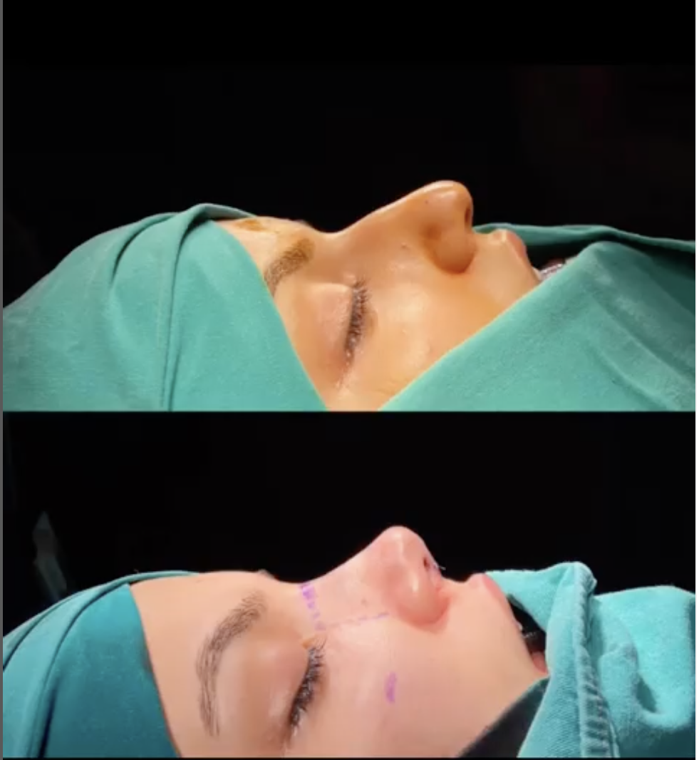 Rhinoplasty, Pic 3.png