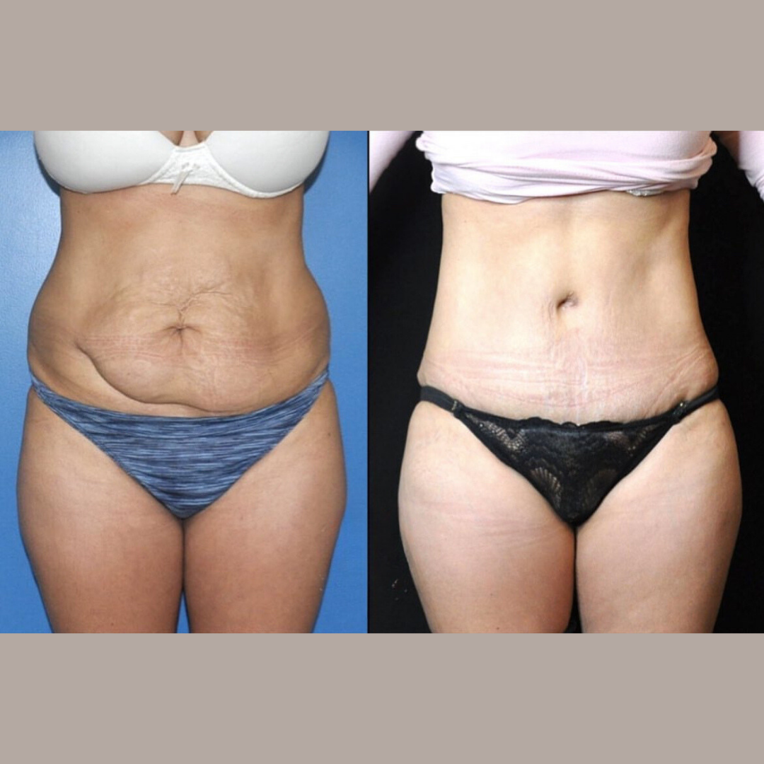 Abdominoplasty, Pic 11.png