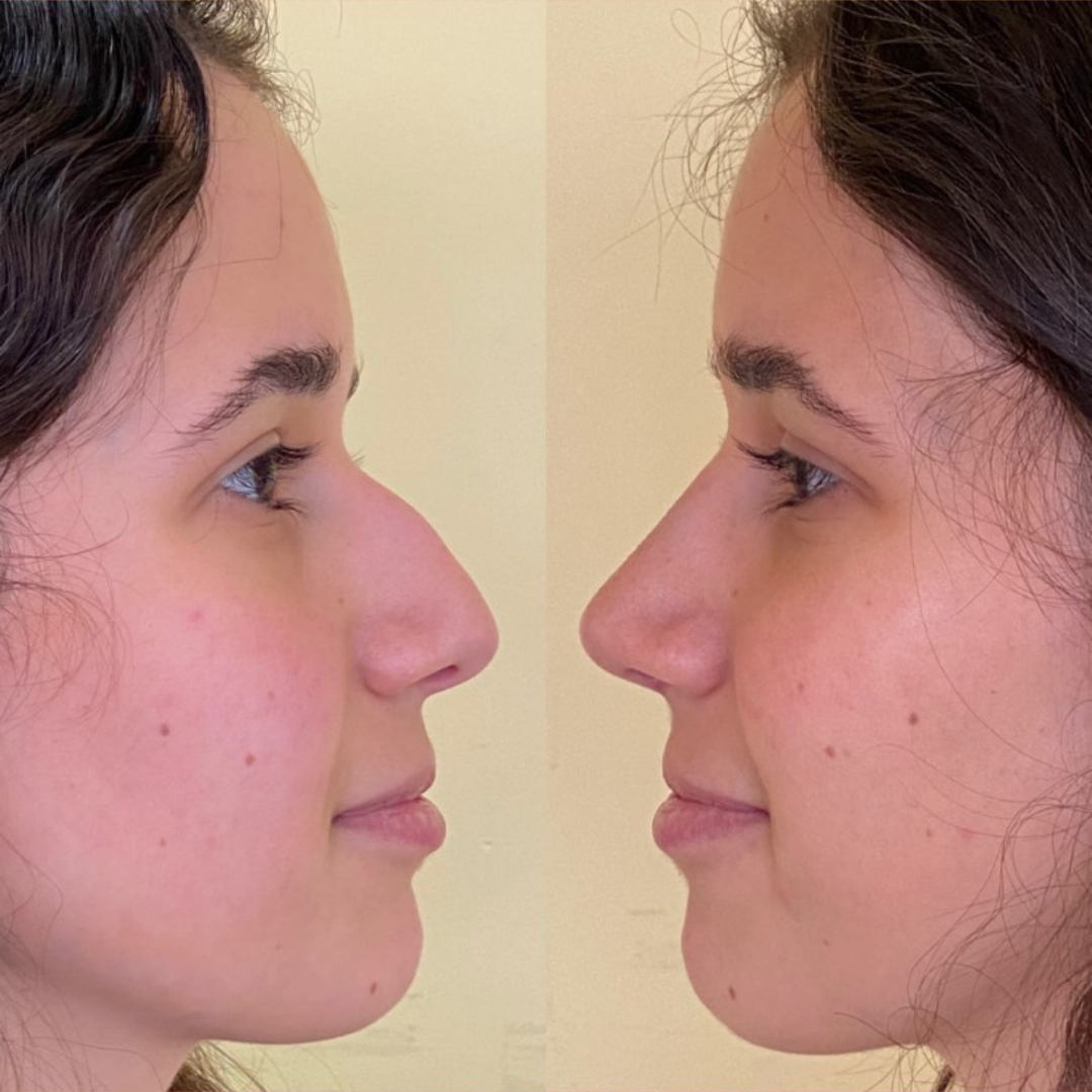 Rhinoplasty in Argentina, Pic 6.png