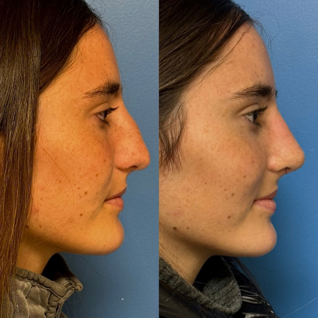 Rhinoplasty with Estedica, Pic 20.png