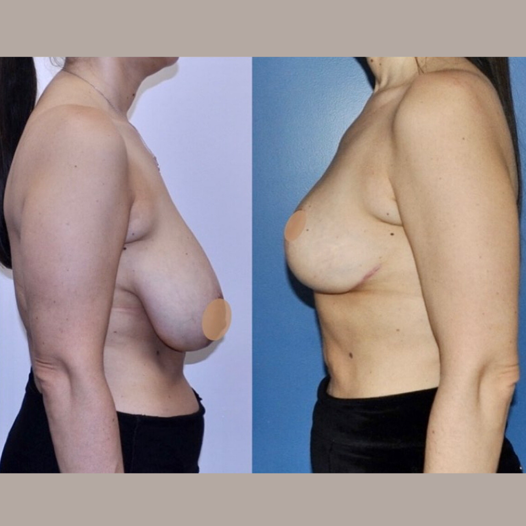 Breast Reduction, Pic 7.png
