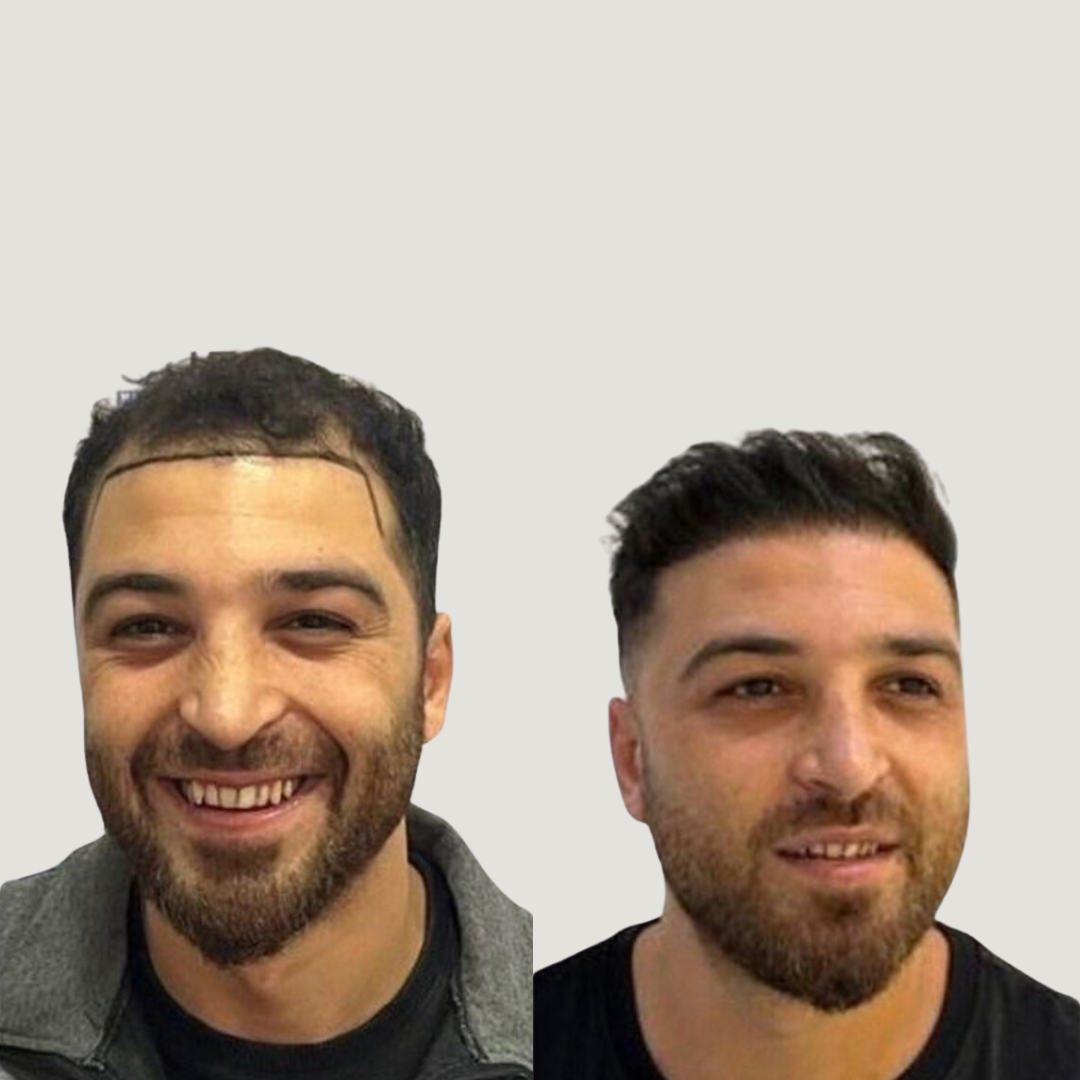 Hair Transplantation Results, Pic 4.png