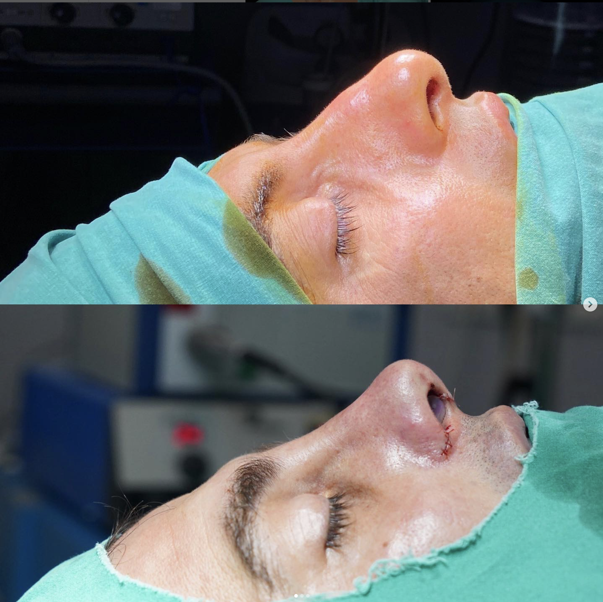 Rhinoplasty, Pic 6.png