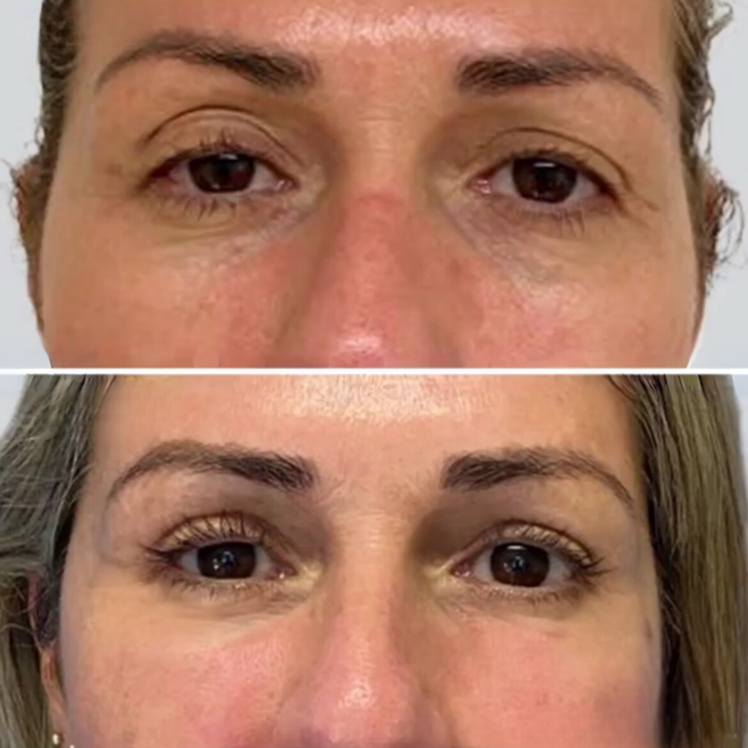 Blepharoplasty, Pic 3.png