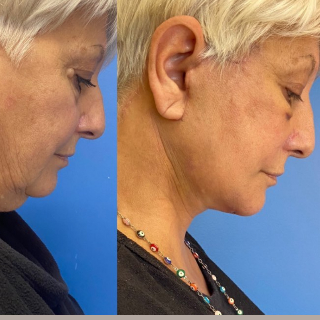Face Lift, Pic 4.png