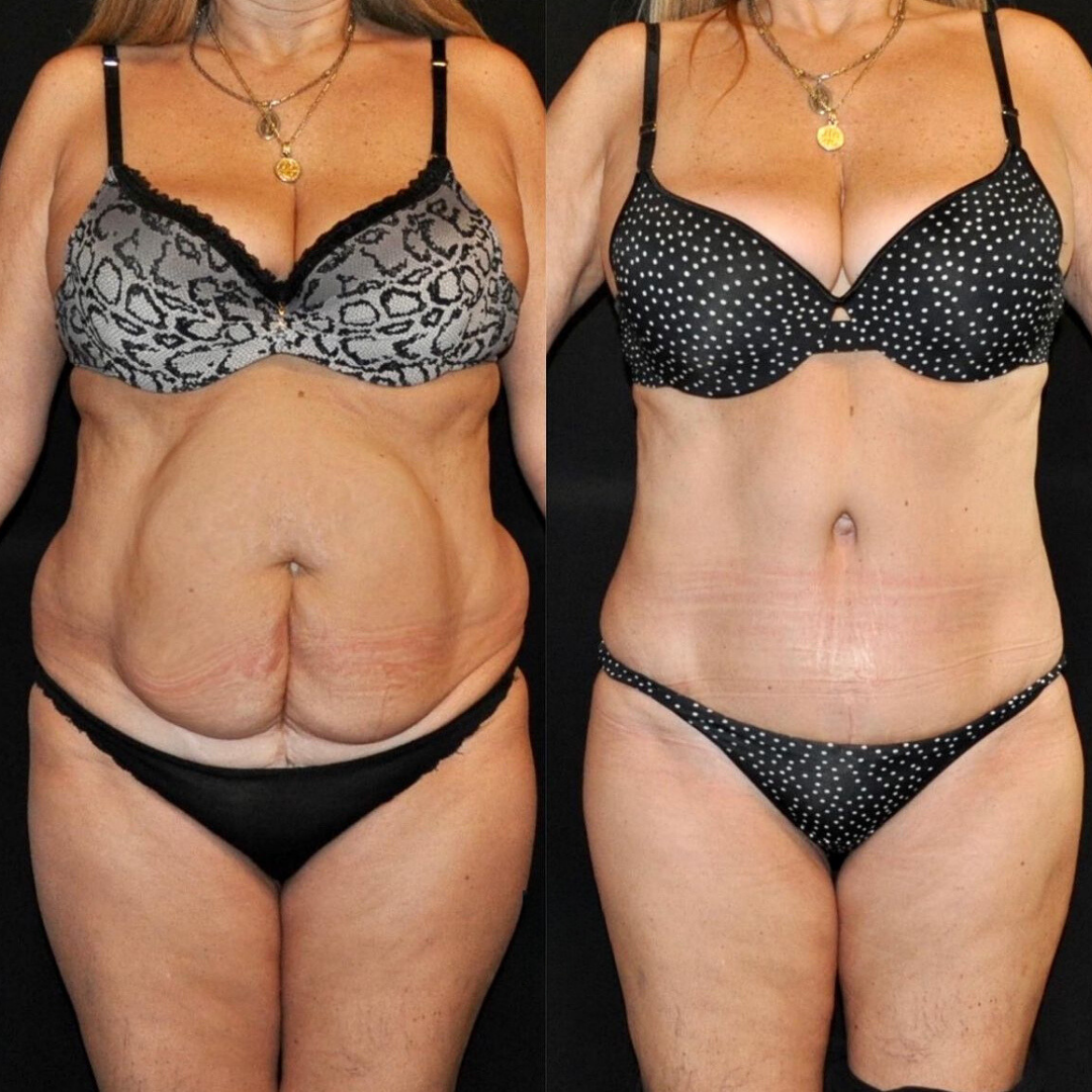 Abdominoplasty, Pic 1.png