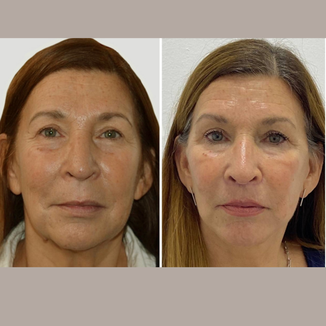 Face Lift, Pic 23.png