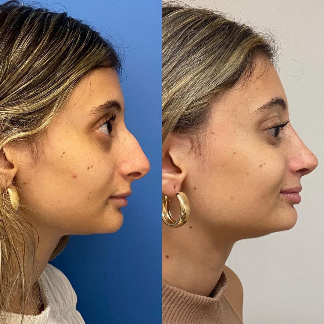 Rhinoplasty with Estedica, Pic 22.png