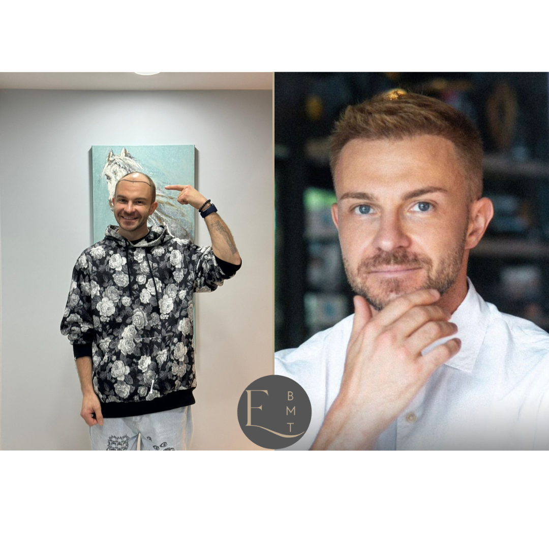 Hair Transplantation, Turkey -1.png