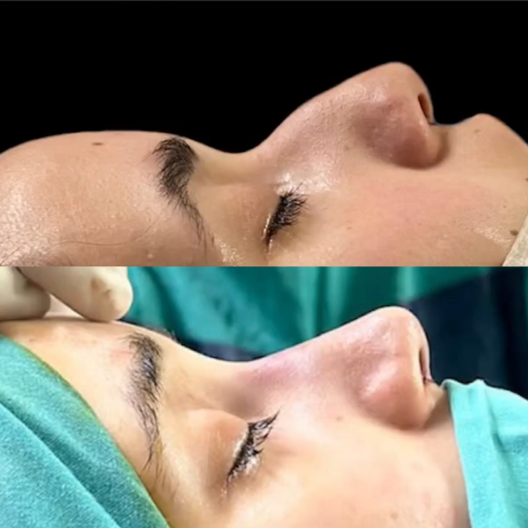 Rhinoplasty in Argentina, Pic 4.png
